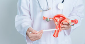 What are uterine fibroids, symptoms, causes, who gets them, different types & treatment options from endocrinologist/gynecologist GV Burke MD